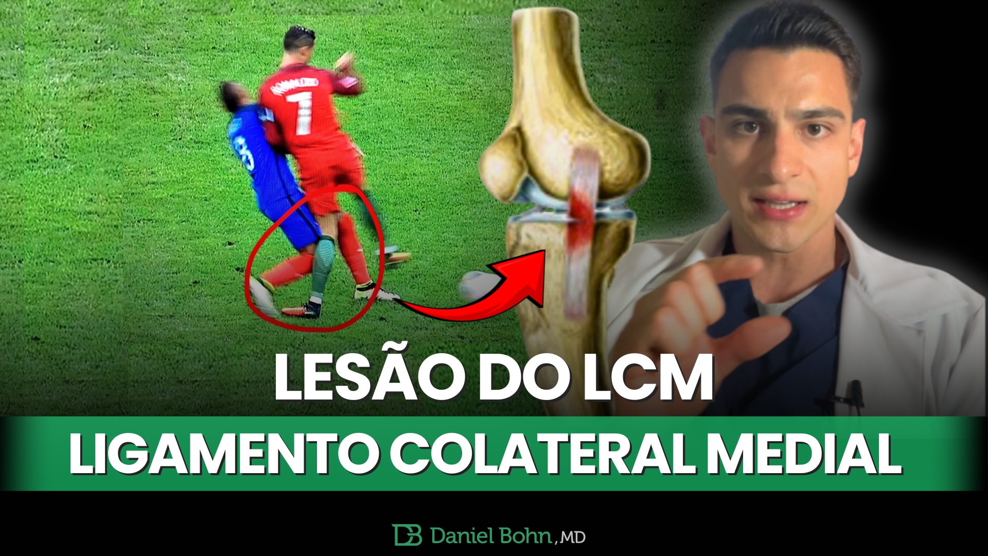 lesao LCM