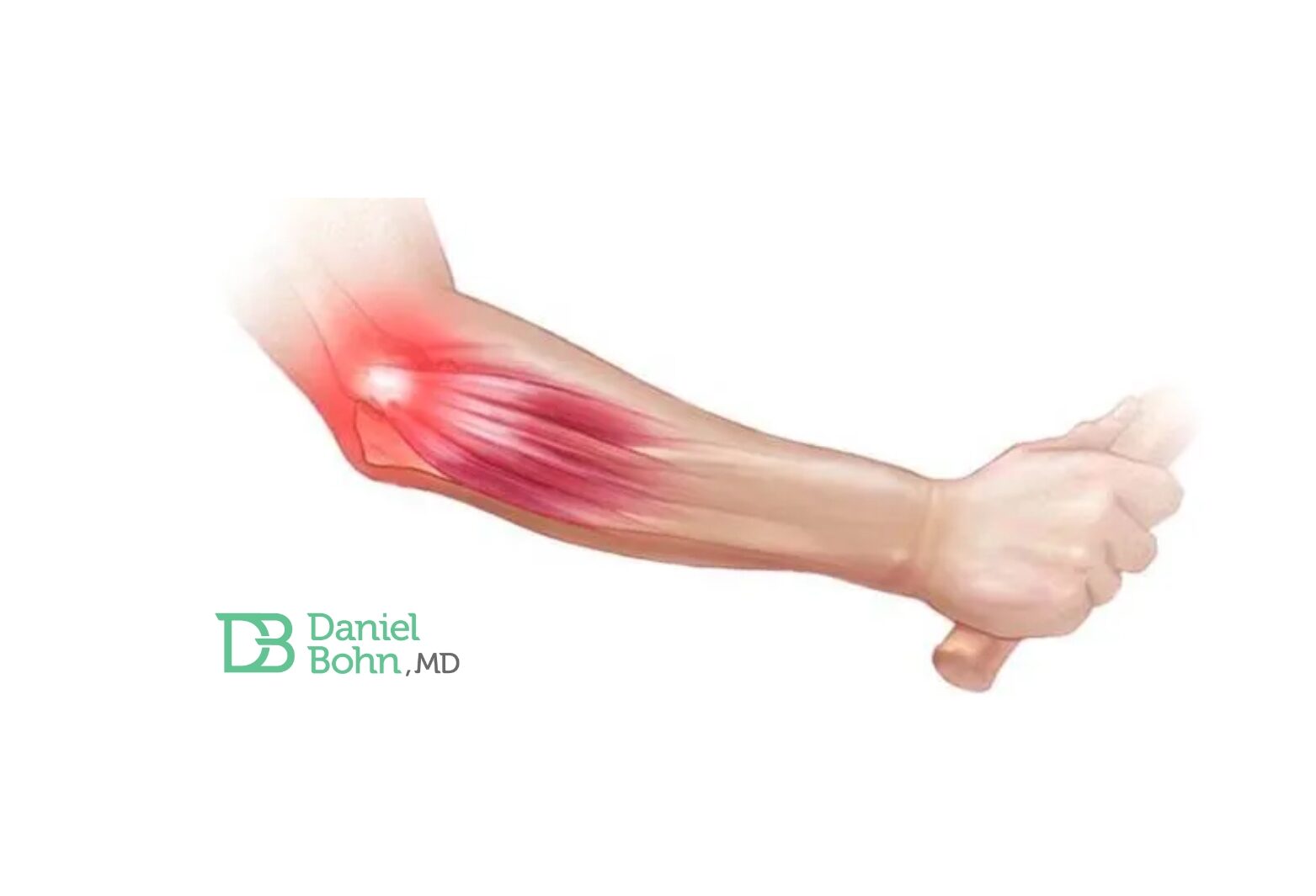 Epicondilite lateral