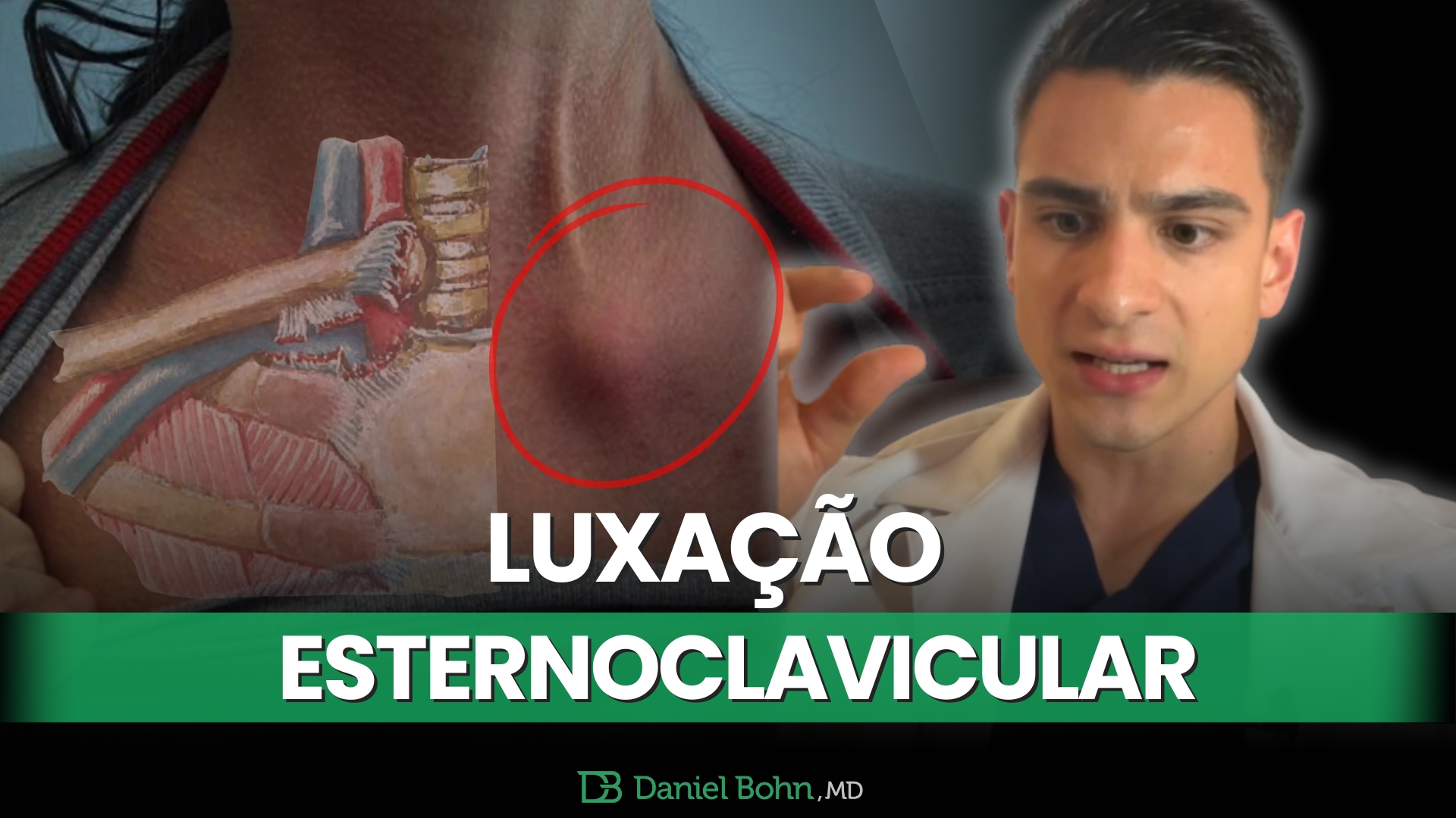 Luxacao esternoclavicular