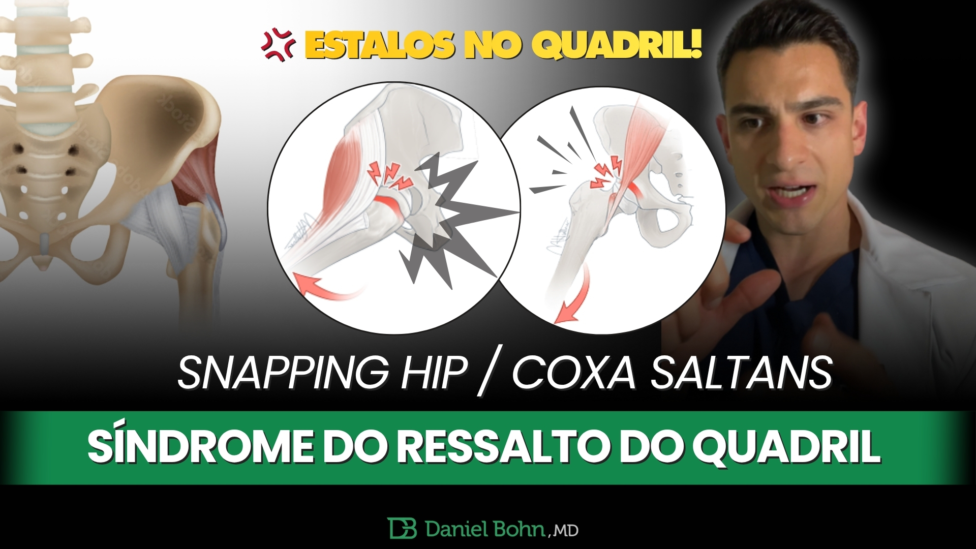 Snapping hip, síndrome do ressalto do quadril, coxa saltans, quadril estralando