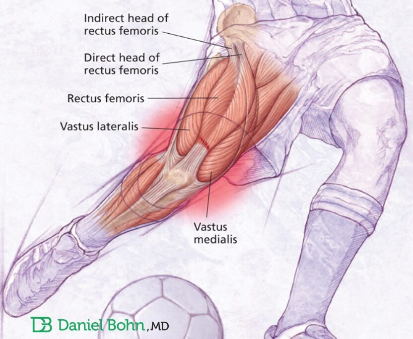 lesao quadriceps reto femoral