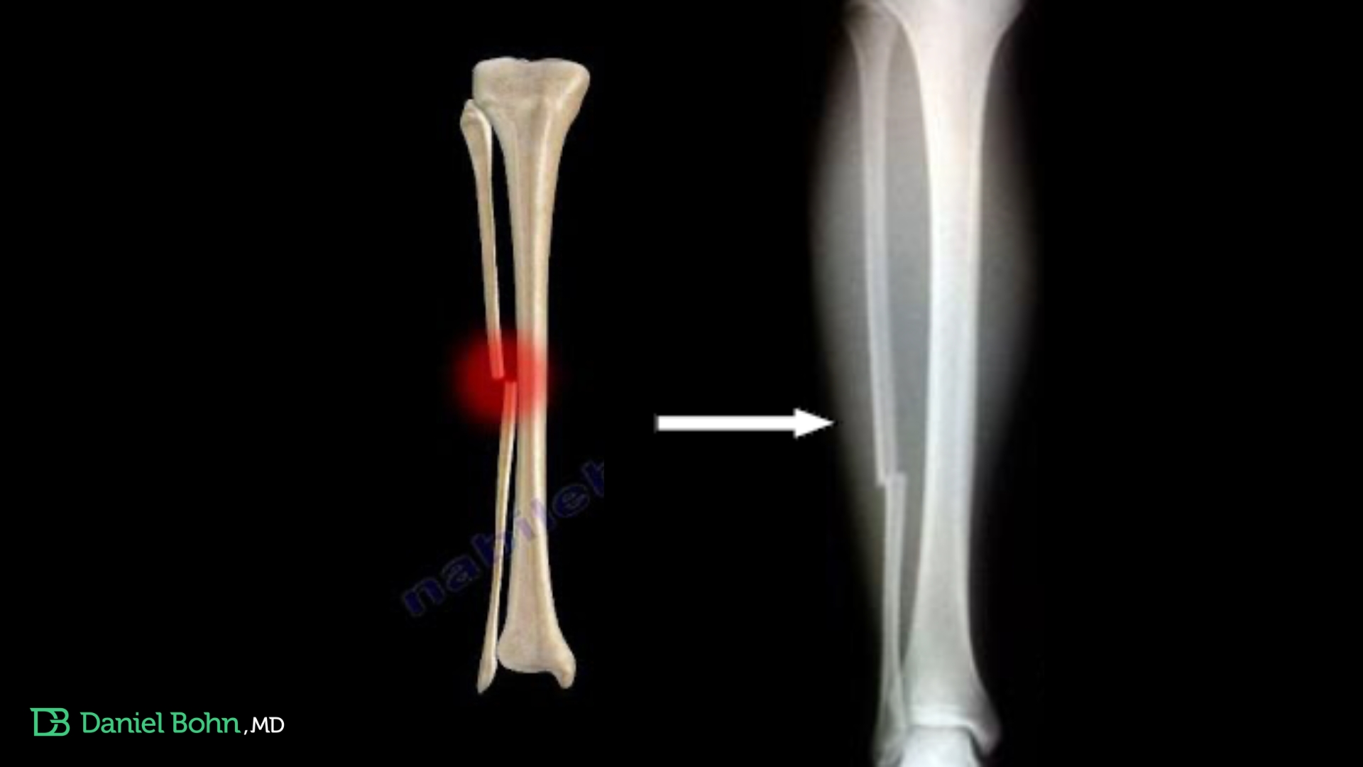 fratura isolada da fibula