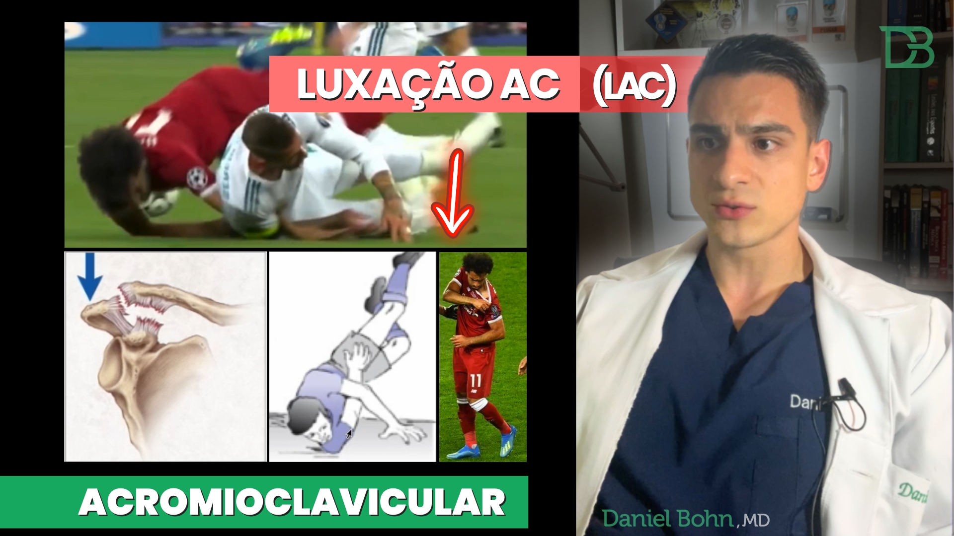 LUXAÇÃO ACROMIOCLAVICULAR LAC