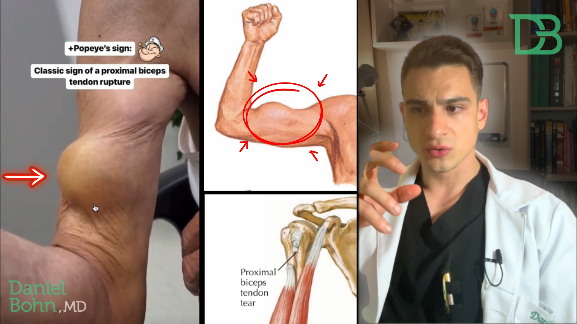 lesao Cabeca longa do biceps