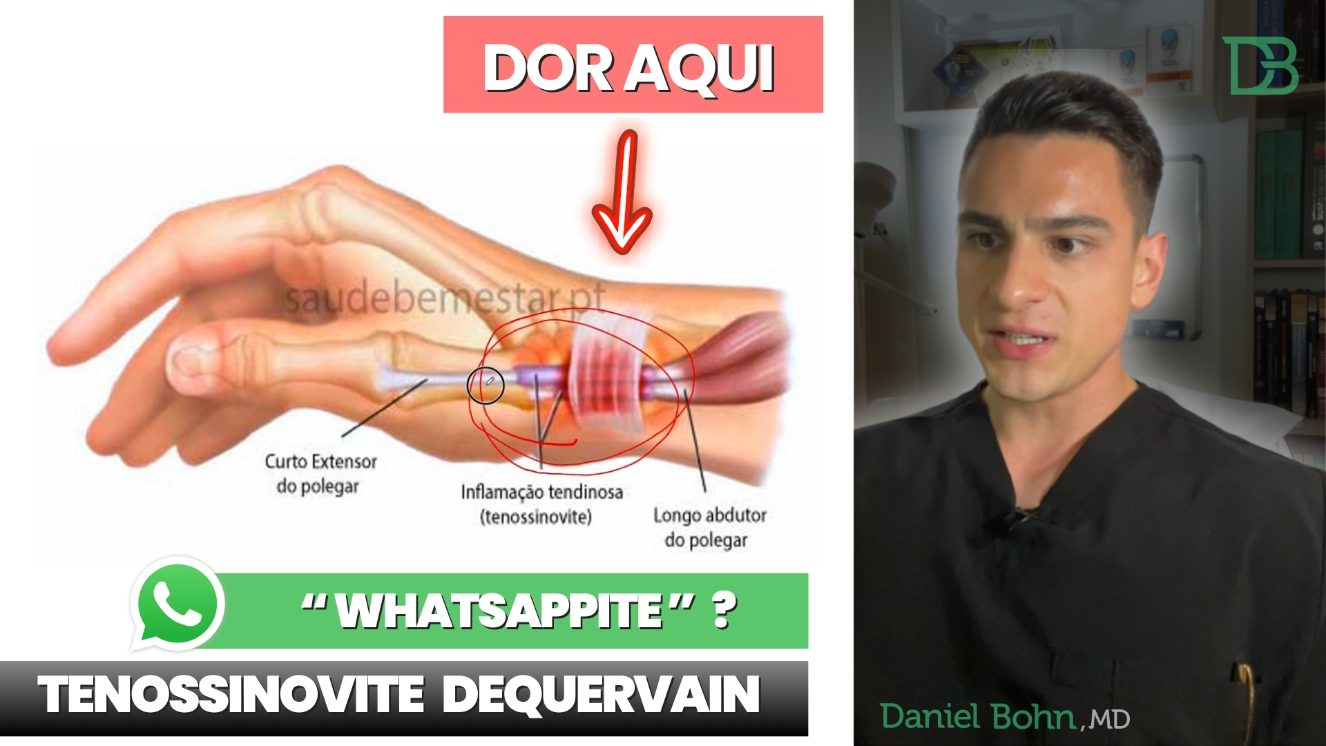 tenossinovite de quervain