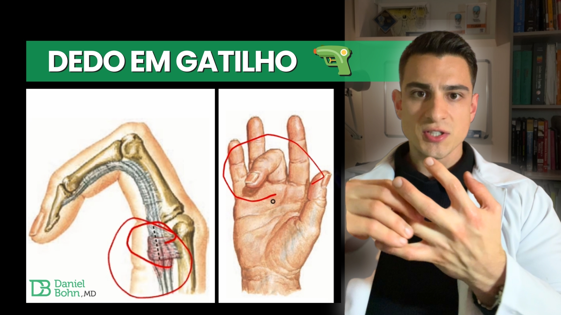 Dedo em Gatilho