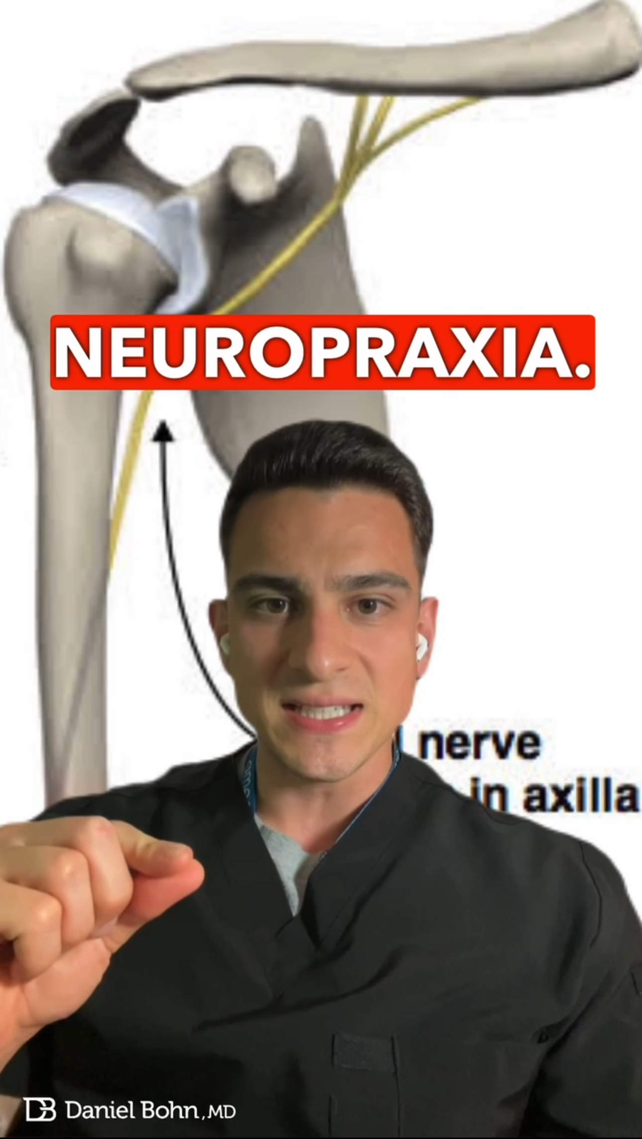 Neuropraxia do nervo radial Daniel Bohn paralisia sábado a noite