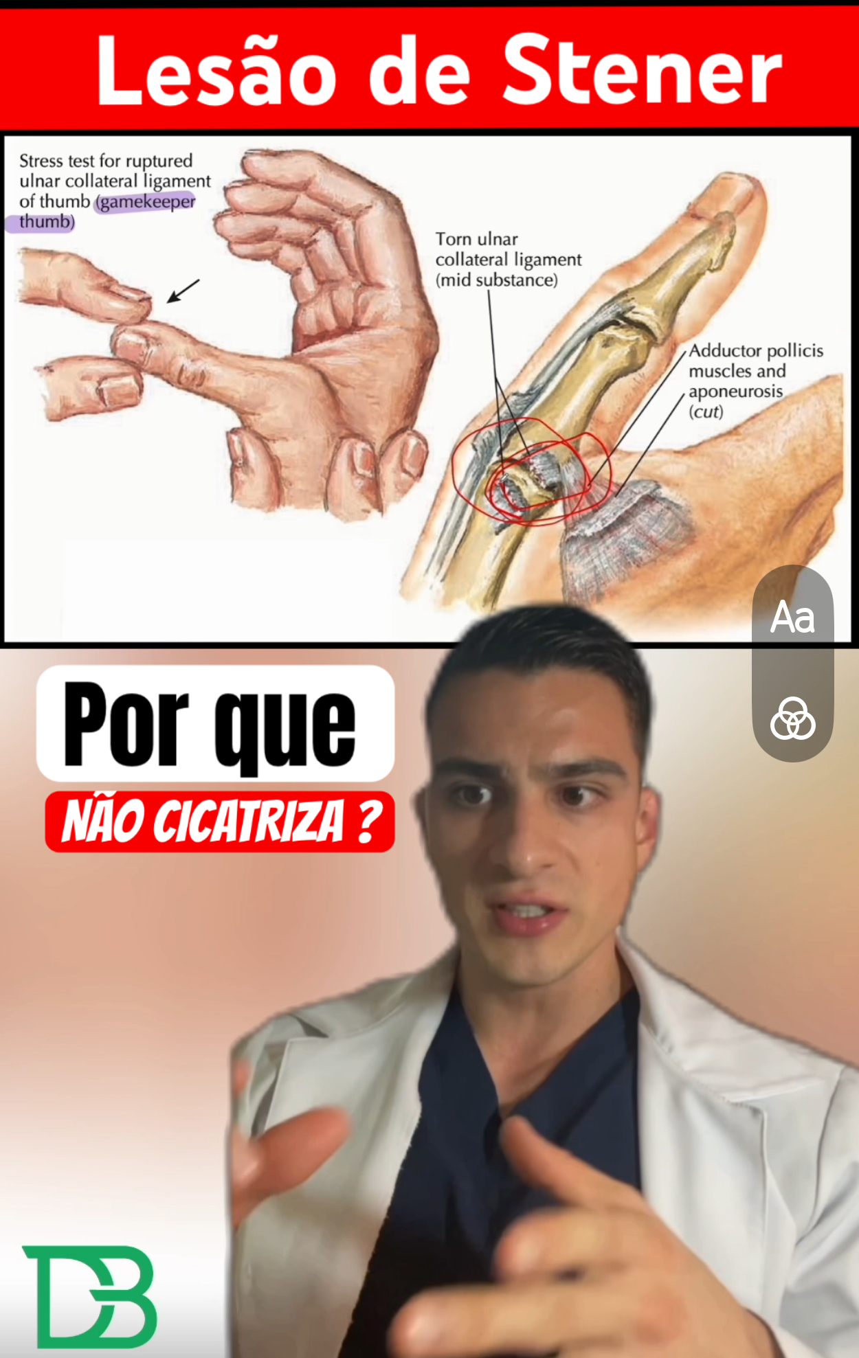 Lesão de Stender Daniel Bohn anatomia